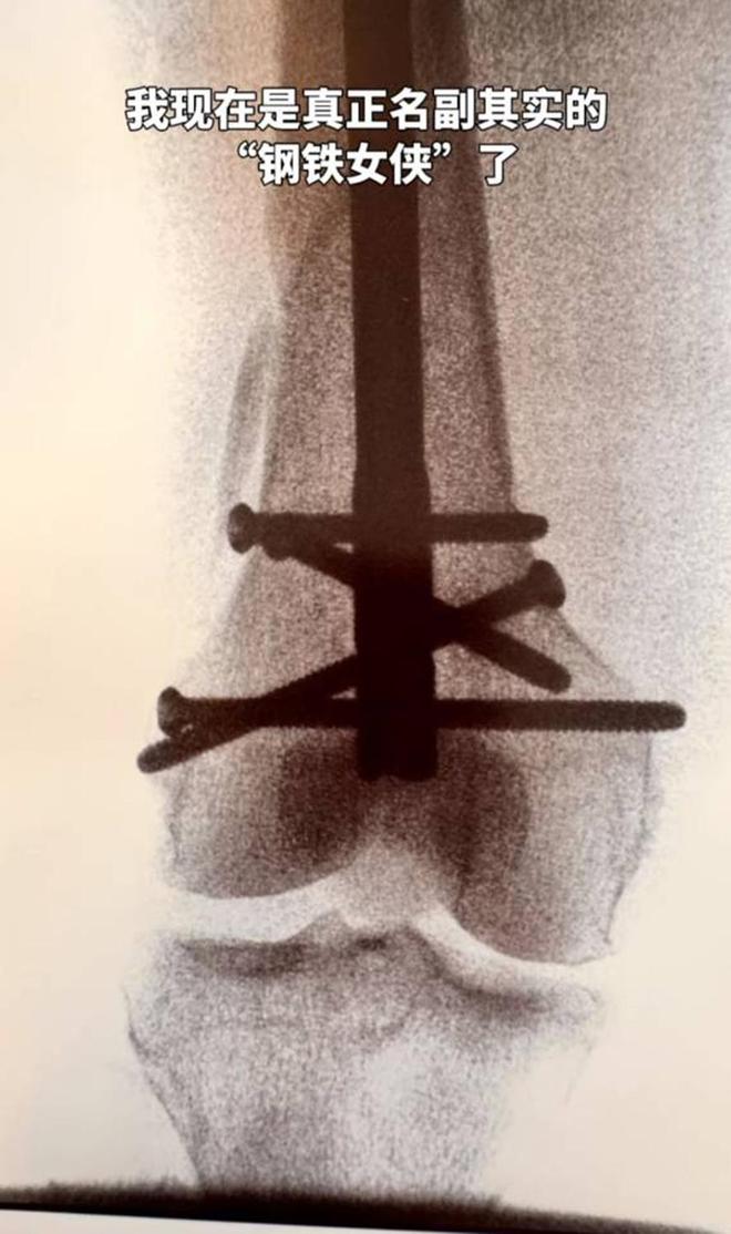 半岛·体育(中国)官方网站向太家中滑倒致大腿骨裂手术足足进行了5小时向华强全程陪(图7)