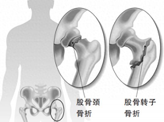 半岛·体育(中国)官方网站涉及20万人的研究发现：10月老人最容易跌倒